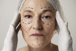 Facelift
