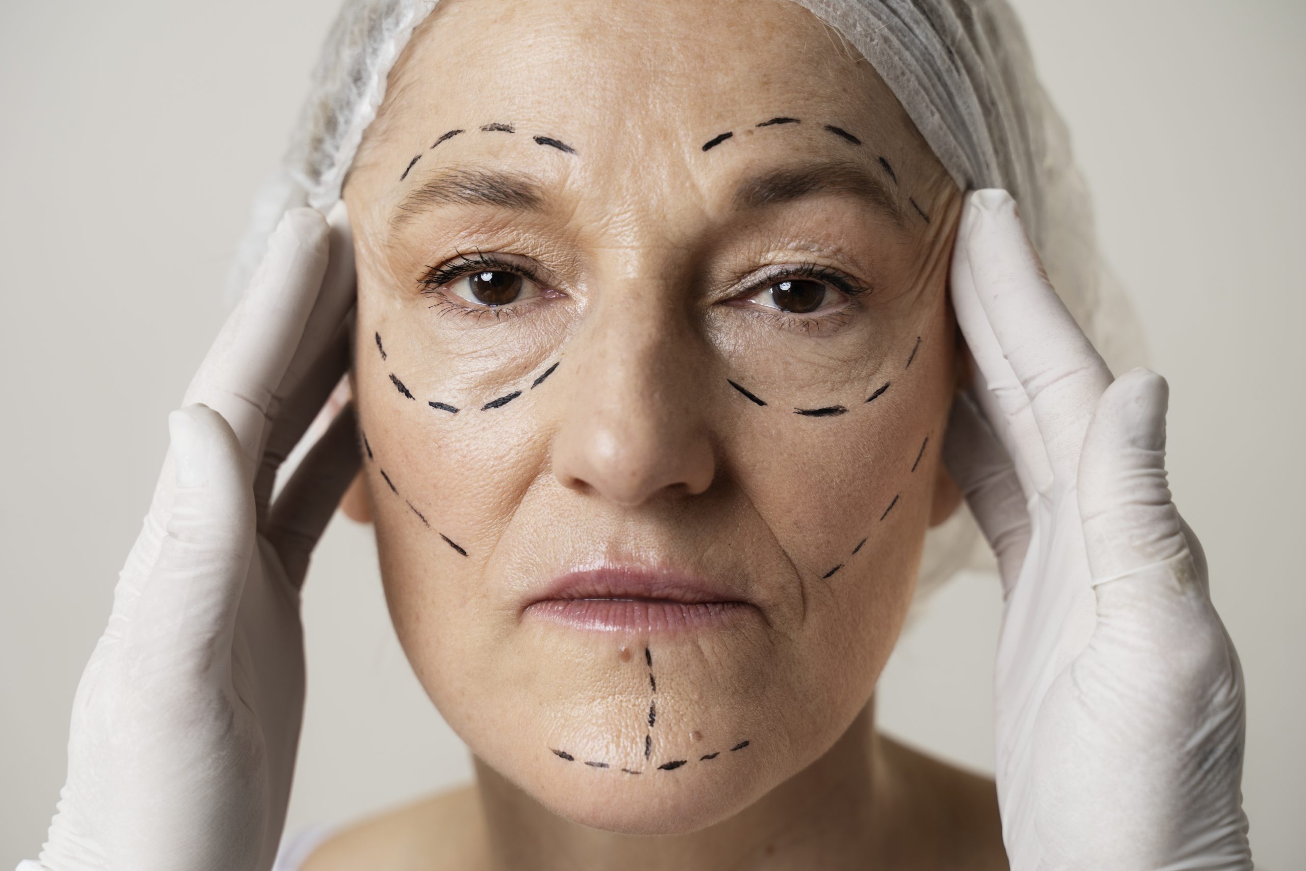 Read more about the article Deep Plane Facelift Recovery Timeline: Week-by-Week Guide