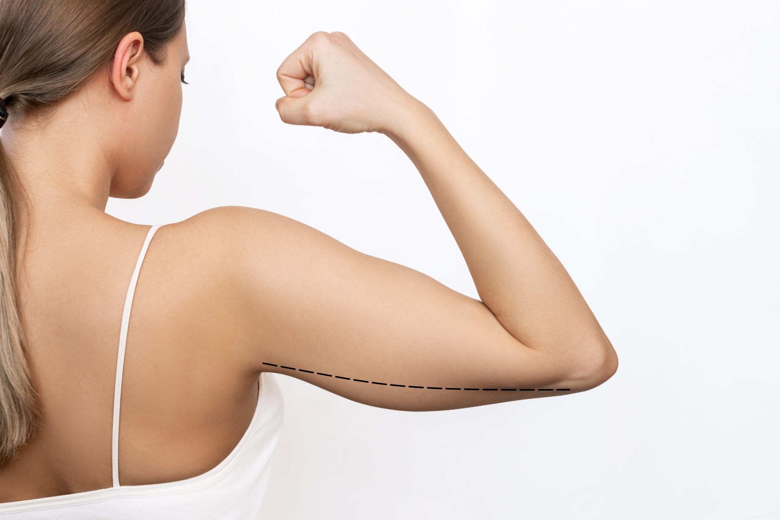 Read more about the article Arm Lift Recovery Timeline: Week by Week Guide
